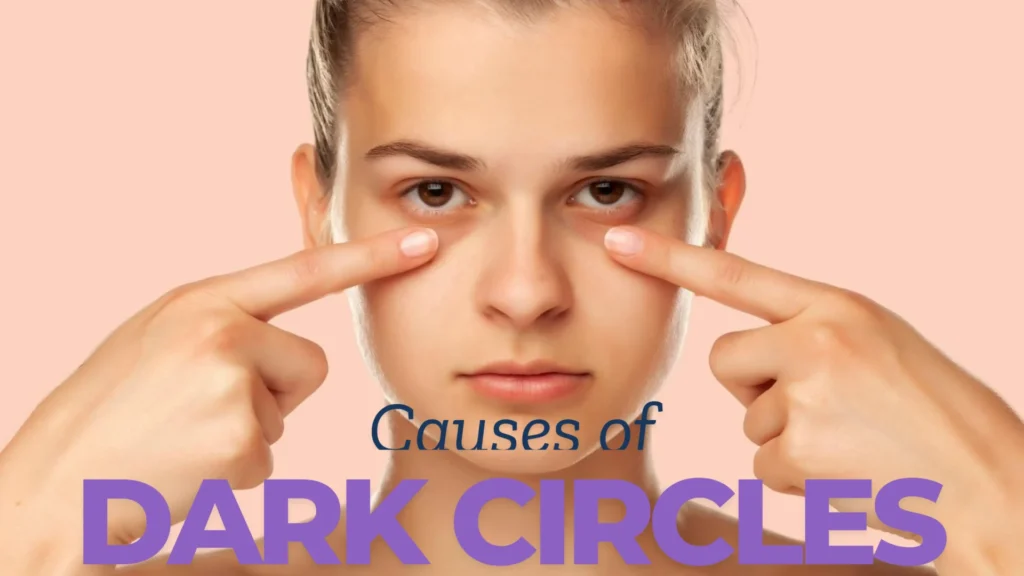 Causes of dark circles